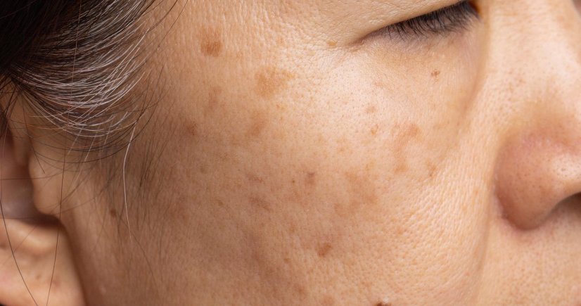 Laser Treatment for pigmentation